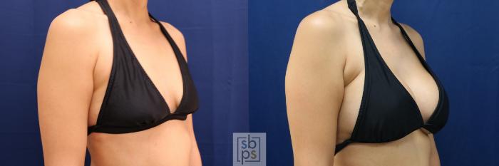 Before & After Breast Augmentation Case 662 Bikini Right Oblique View in Torrance, CA