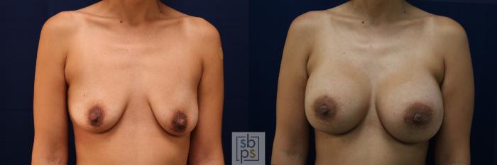 Before & After Breast Augmentation Case 662 Front View in Torrance, CA