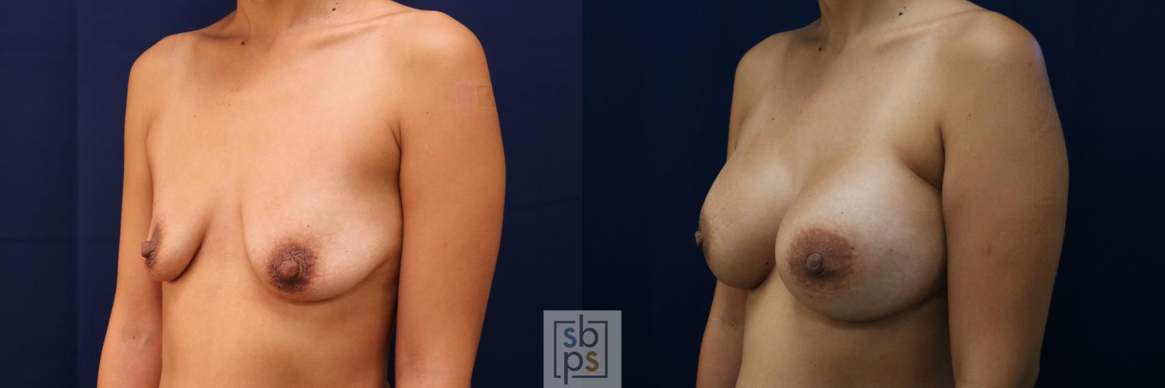 Before & After Breast Augmentation Case 662 Left Oblique View in Torrance & Los Angeles, CA, CA