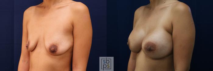 Before & After Breast Augmentation Case 662 Left Oblique View in Torrance, CA