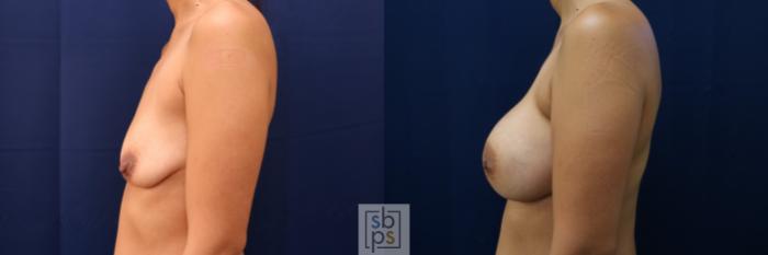 Before & After Breast Augmentation Case 662 Left Side View in Torrance, CA