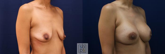 Before & After Breast Augmentation Case 662 Right Oblique View in Torrance, CA