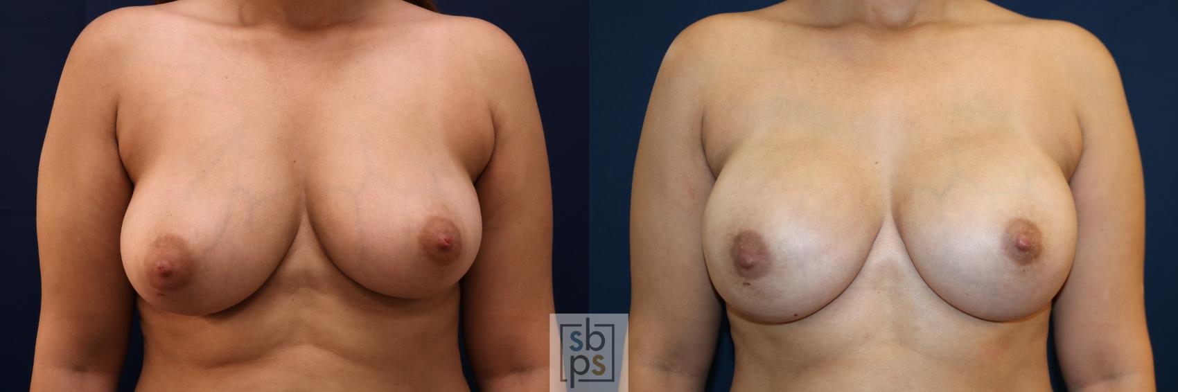 Before & After Breast Augmentation Case 663 Front View in Torrance, CA