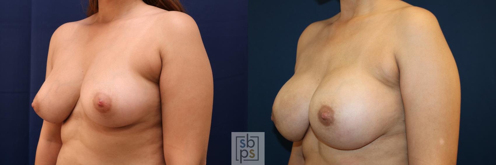 Before & After Breast Augmentation Case 663 Left Oblique View in Torrance & Los Angeles, CA, CA