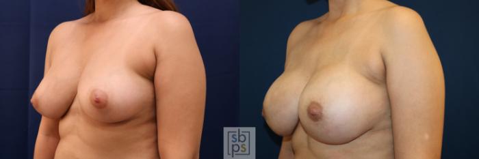 Before & After Breast Augmentation Case 663 Left Oblique View in Torrance, CA