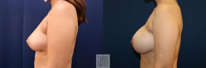 Before & After Breast Augmentation Case 663 Left Side View in Torrance, CA