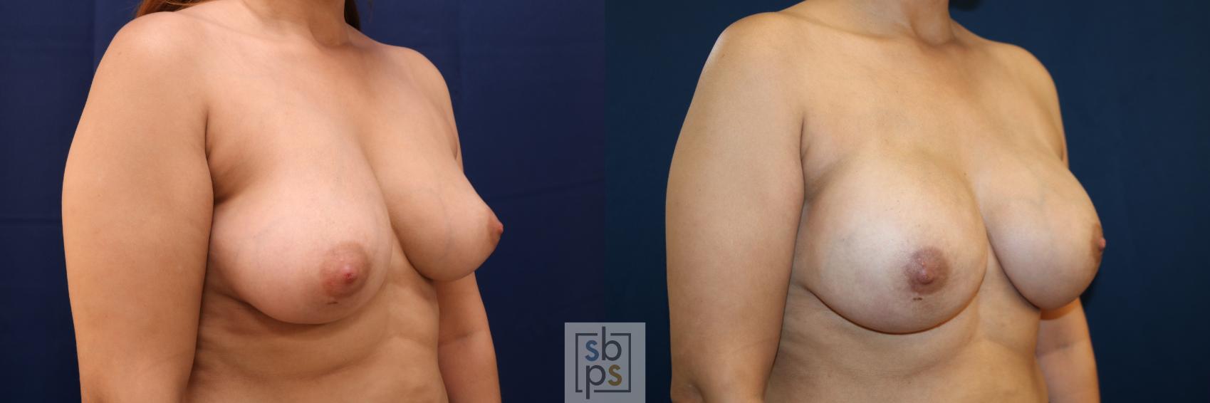 Before & After Breast Augmentation Case 663 Right Oblique View in Torrance & Los Angeles, CA, CA