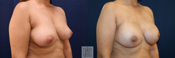 Before & After Breast Augmentation Case 663 Right Oblique View in Torrance, CA