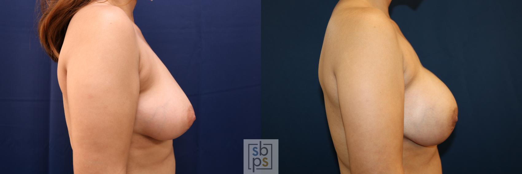 Before & After Breast Augmentation Case 663 Right Side View in Torrance & Los Angeles, CA, CA