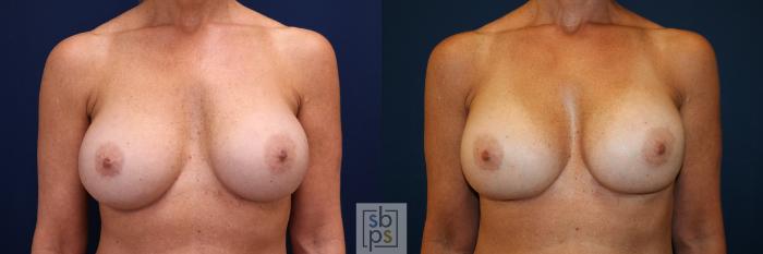 Before & After Breast Augmentation Case 664 Front View in Torrance, CA