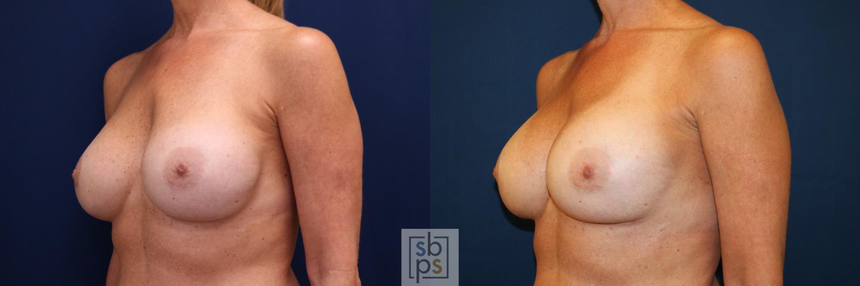 Before & After Breast Augmentation Case 664 Left Oblique View in Torrance & Los Angeles, CA, CA