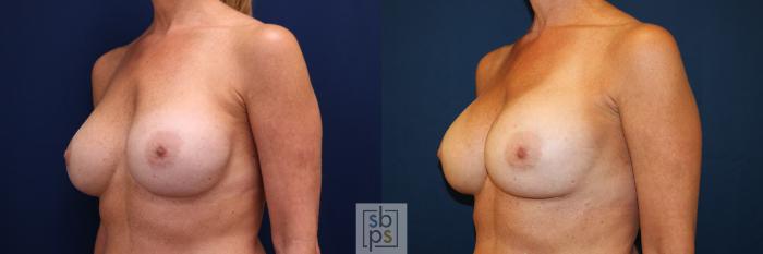 Before & After Breast Augmentation Case 664 Left Oblique View in Torrance, CA