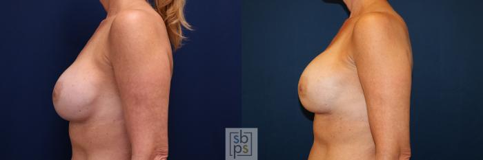 Before & After Breast Augmentation Case 664 Left Side View in Torrance, CA