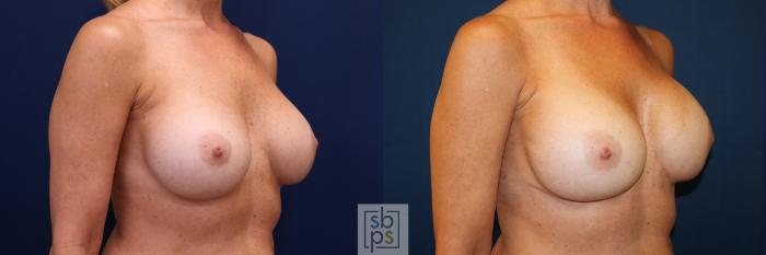 Before & After Breast Augmentation Case 664 Right Oblique View in Torrance, CA