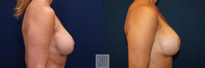 Before & After Breast Augmentation Case 664 Right Side View in Torrance, CA