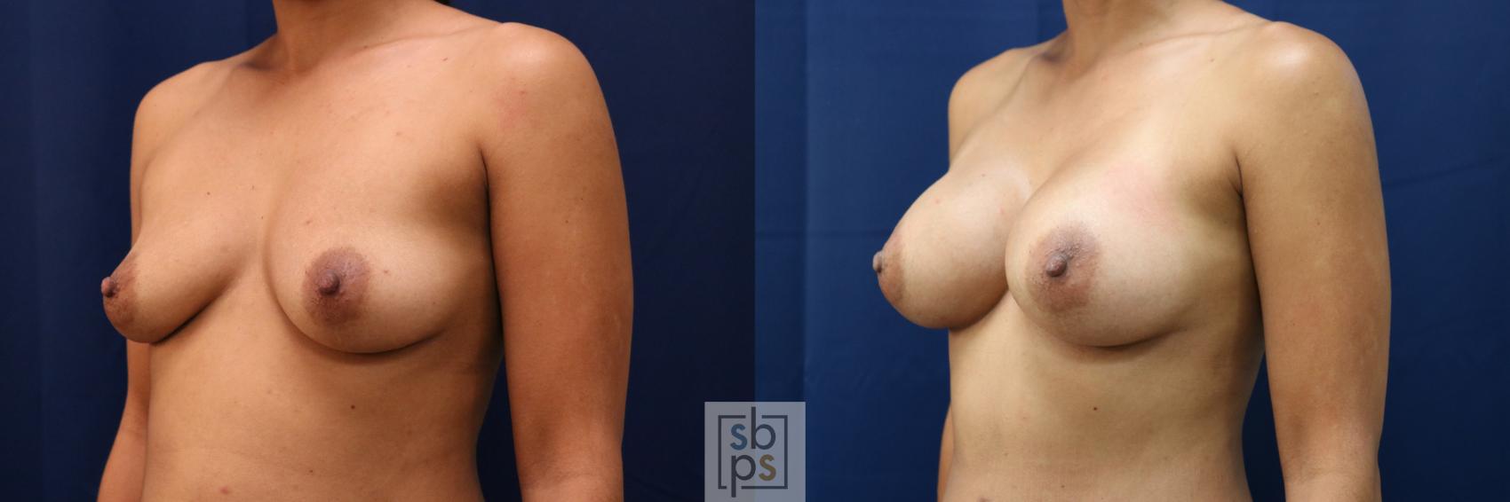 Before & After Breast Augmentation Case 665 Left Oblique View in Torrance & Los Angeles, CA, CA