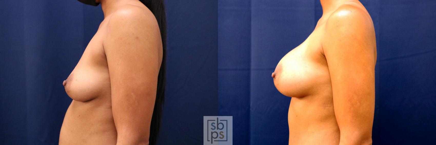 Before & After Breast Augmentation Case 665 Left Side View in Torrance & Los Angeles, CA, CA