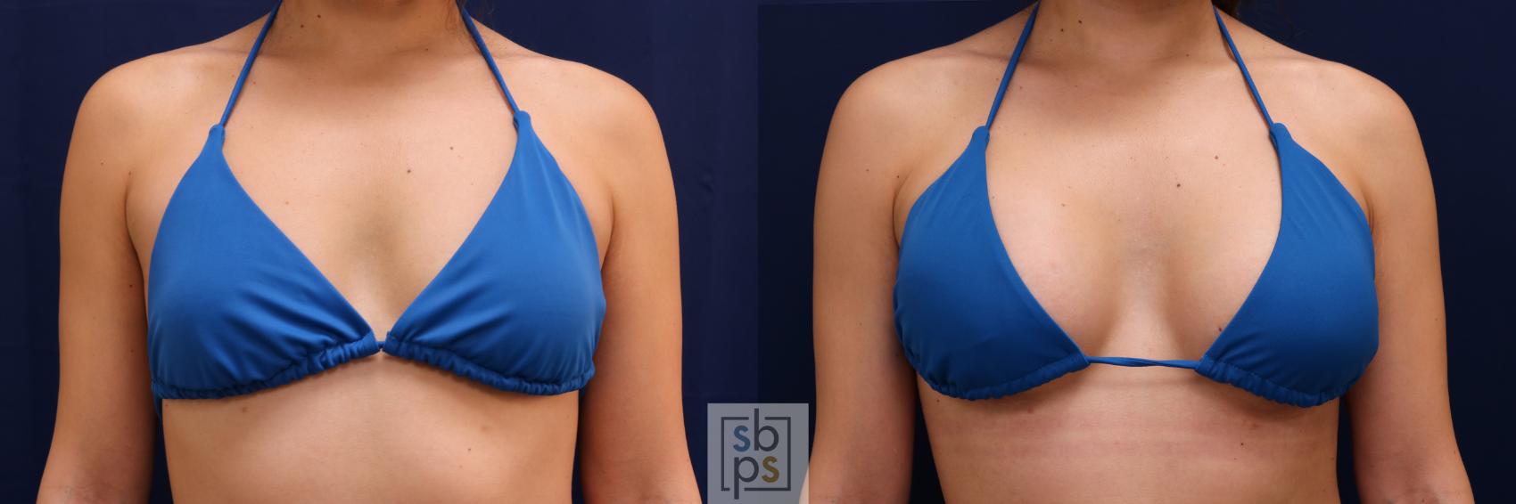 Before & After Breast Augmentation Case 666 Bikini Front View in Torrance & Los Angeles, CA, CA