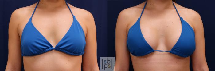 Before & After Breast Augmentation Case 666 Bikini Front View in Torrance, CA