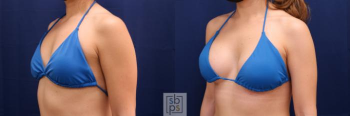 Before & After Breast Augmentation Case 666 Bikini Left Oblique View in Torrance, CA
