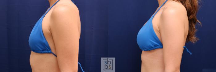Before & After Breast Augmentation Case 666 Bikini Left View in Torrance, CA