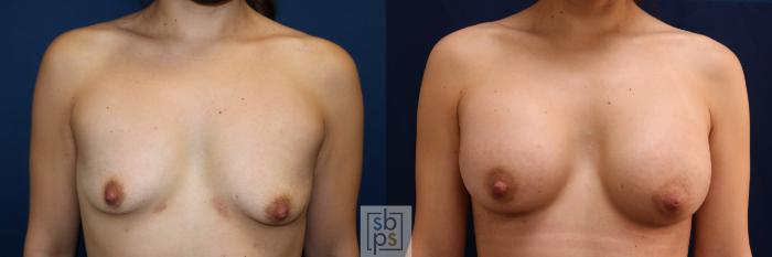 Before & After Breast Augmentation Case 666 Front View in Torrance, CA