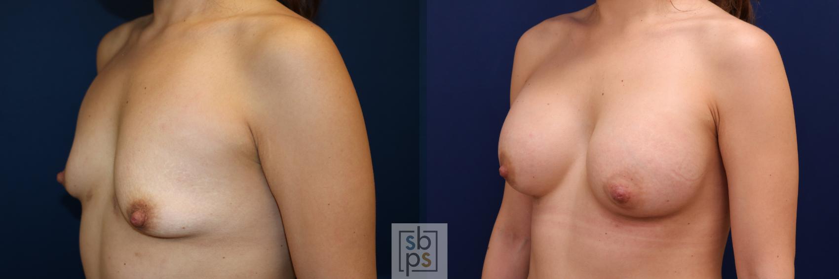 Before & After Breast Augmentation Case 666 Left Oblique View in Torrance & Los Angeles, CA, CA