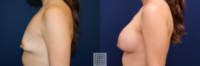 Before & After Breast Augmentation Case 666 Left Side View in Torrance, CA