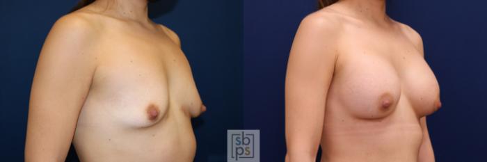 Before & After Breast Augmentation Case 666 Right Oblique View in Torrance, CA