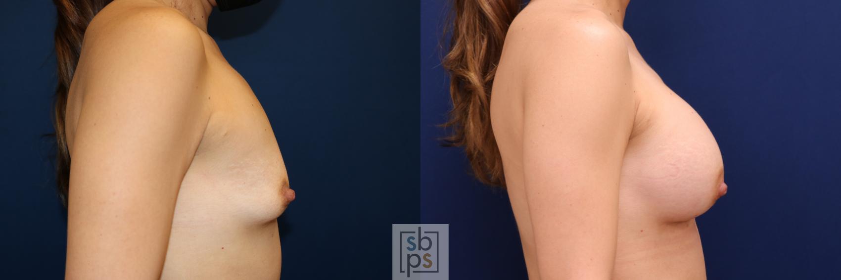 Before & After Breast Augmentation Case 666 Right Side View in Torrance & Los Angeles, CA, CA