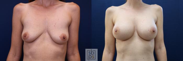Before & After Breast Augmentation Case 672 Front View in Torrance, CA