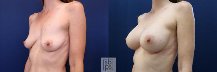 Before & After Breast Augmentation Case 672 Left Oblique View in Torrance, CA