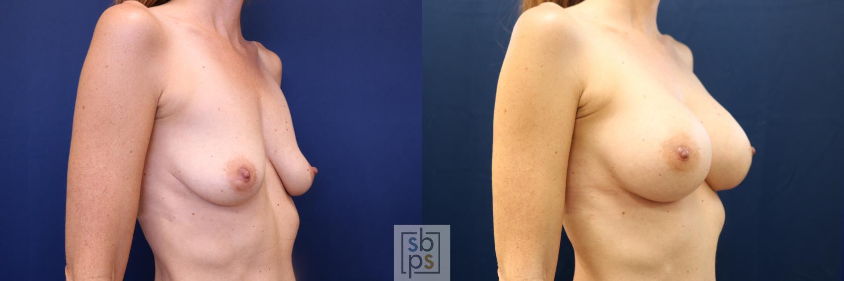 Before & After Breast Augmentation Case 672 Right Oblique View in Torrance & Los Angeles, CA, CA