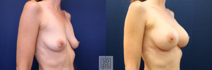 Before & After Breast Augmentation Case 672 Right Oblique View in Torrance, CA