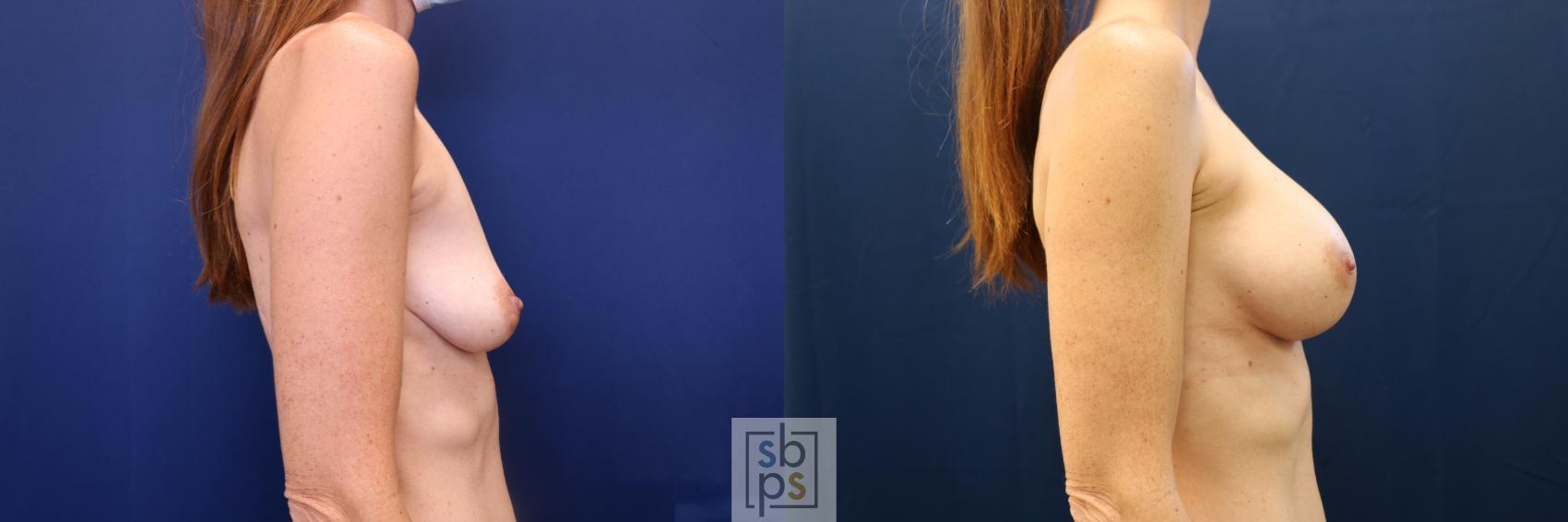 Before & After Breast Augmentation Case 672 Right Side View in Torrance & Los Angeles, CA, CA