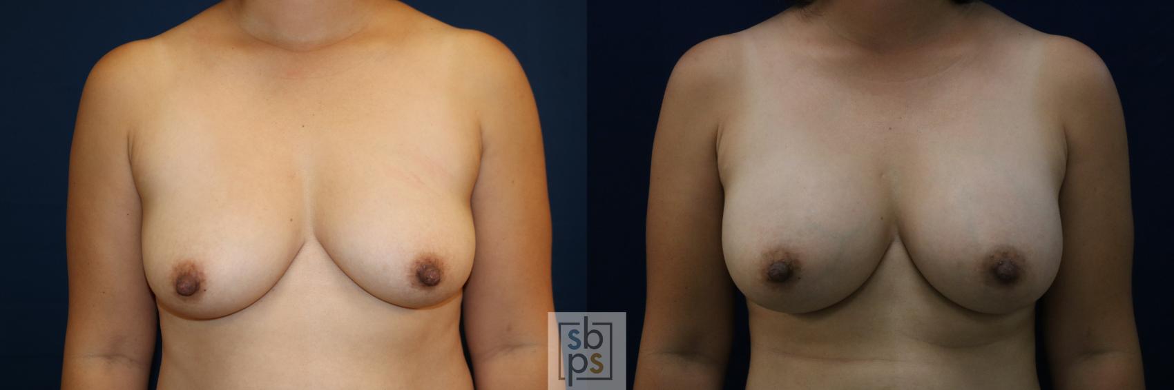 Before & After Breast Augmentation Case 676 Front View in Torrance, CA