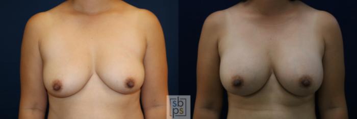 Before & After Breast Augmentation Case 676 Front View in Torrance, CA