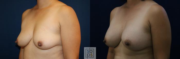 Before & After Breast Augmentation Case 676 Left Oblique View in Torrance, CA