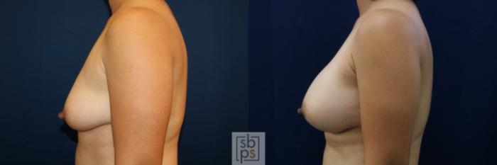 Before & After Breast Augmentation Case 676 Left Side View in Torrance, CA