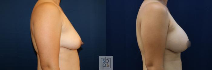 Before & After Breast Augmentation Case 676 Right Side View in Torrance, CA