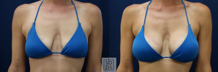 Before & After Breast Augmentation Case 677 Bikini Front View in Torrance, CA