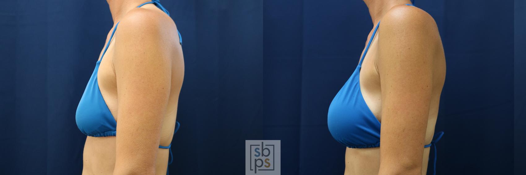 Before & After Breast Augmentation Case 677 Bikini Left View in Torrance & Los Angeles, CA, CA