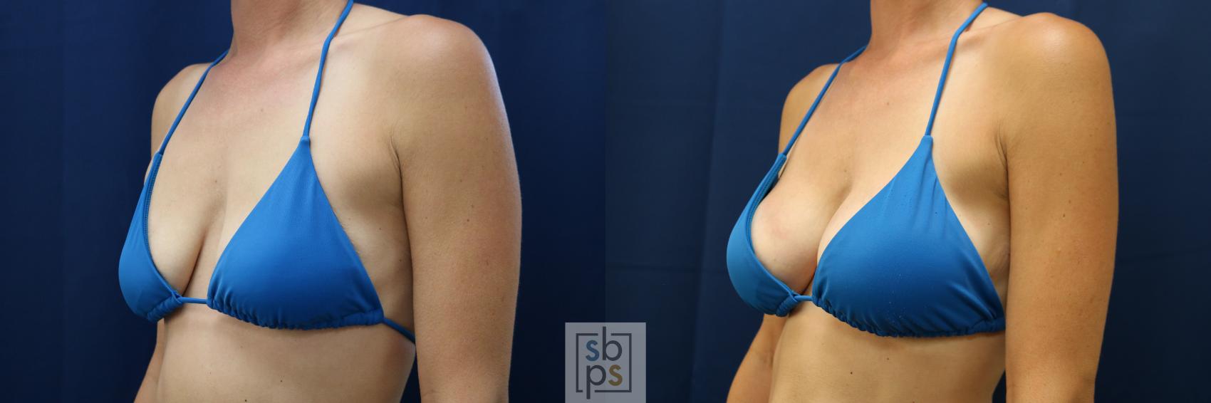 Before & After Breast Augmentation Case 677 Bikini Left Oblique View in Torrance & Los Angeles, CA, CA