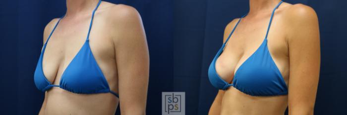 Before & After Breast Augmentation Case 677 Bikini Left Oblique View in Torrance, CA