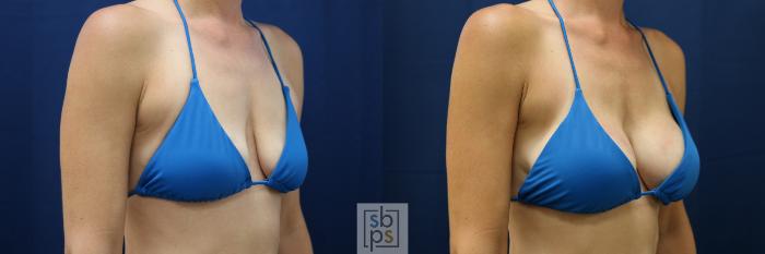 Before & After Breast Augmentation Case 677 Bikini Right Oblique View in Torrance, CA