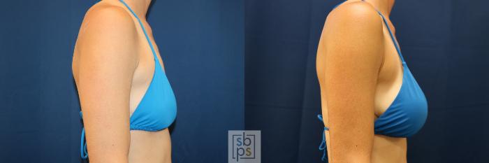 Before & After Breast Augmentation Case 677 Bikini Right View in Torrance, CA