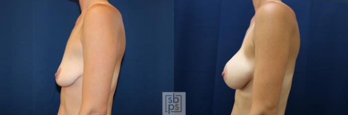 Before & After Breast Augmentation Case 677 Left Side View in Torrance, CA