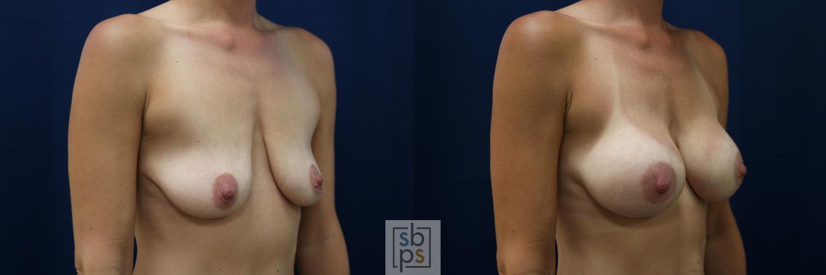 Before & After Breast Augmentation Case 677 Right Oblique View in Torrance & Los Angeles, CA, CA