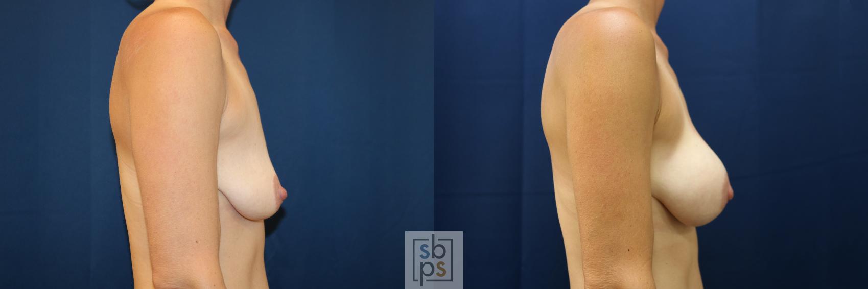Before & After Breast Augmentation Case 677 Right Side View in Torrance & Los Angeles, CA, CA