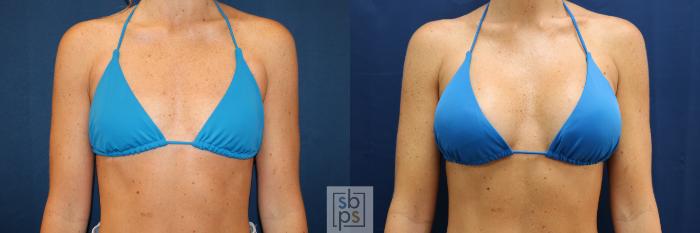 Before & After Breast Augmentation Case 678 Bikini Front View in Torrance, CA